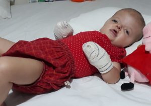 Marcella Vitória recupera-se após a cirurgia na segunda mãozinha