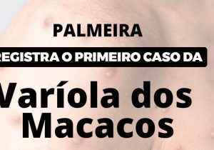 Palmeira registra o primeiro caso da Varíola dos Macacos